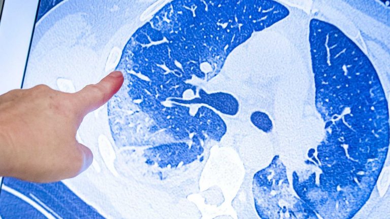 Late Many Covid-19 follow:-patients suffer for months (Video)