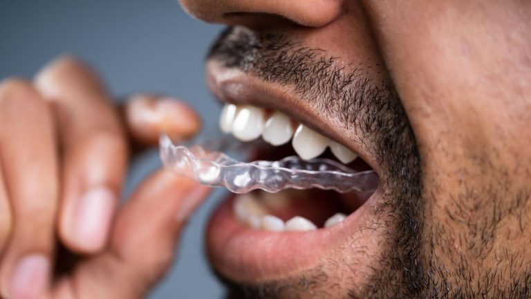 Cleaning the occlusal splint: how to remove deposits